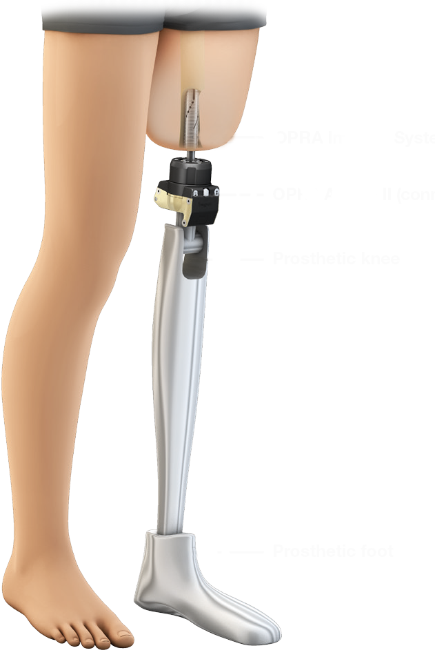 osseointegration