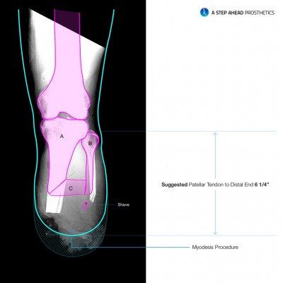 a-step-ahead-prosthetics-ertl procedure 2