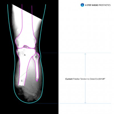astepaheadprosthetics ertl procedure 1