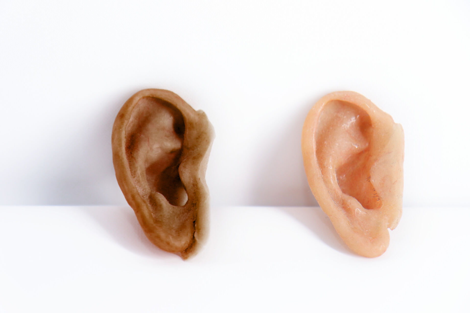 osseointegration silicone ear prosthetics