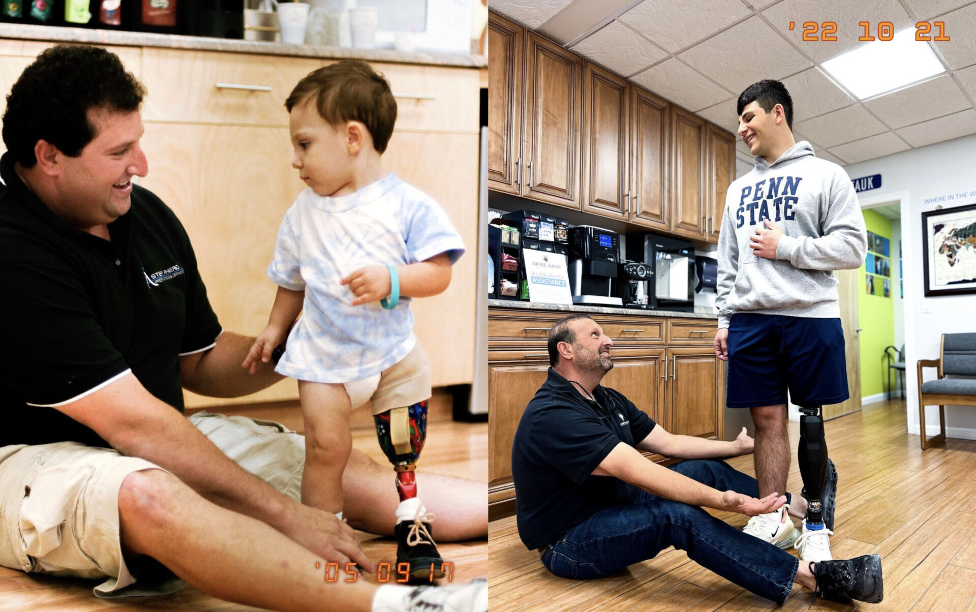 Pediatric Prosthetics Below Knee (BK) for children