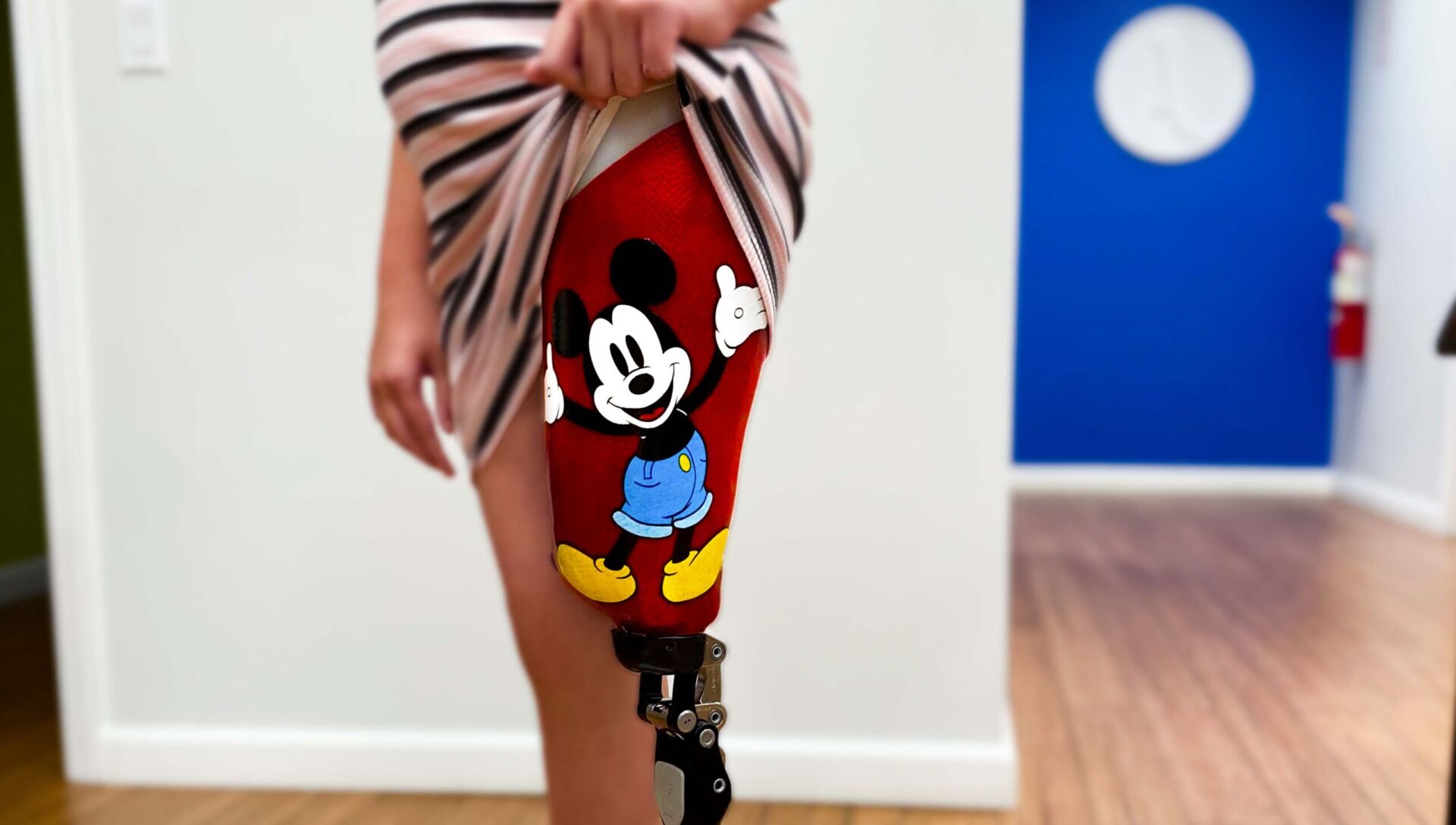 Above Knee Amputee Showing off her Prosthetic Socket Design. She loves using custom tshirt art on her Prosthetic leg!