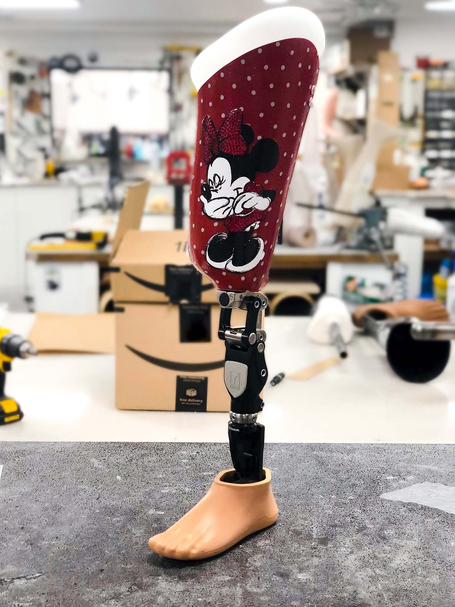 Pediatric Mini mouse inspired AK prosthesis