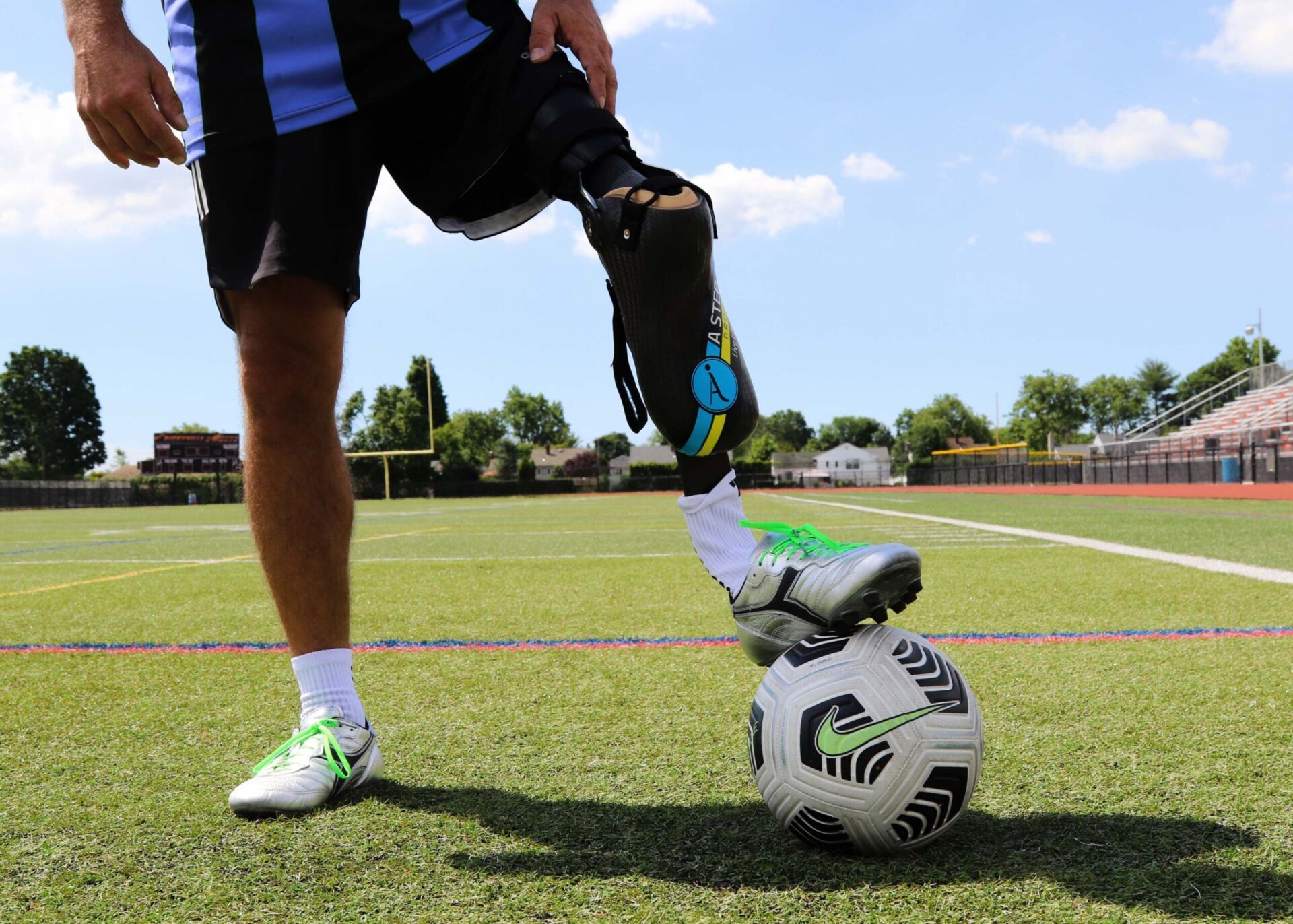 Rotationplasty prosthetic legs for amputees. Soccer parasoccer