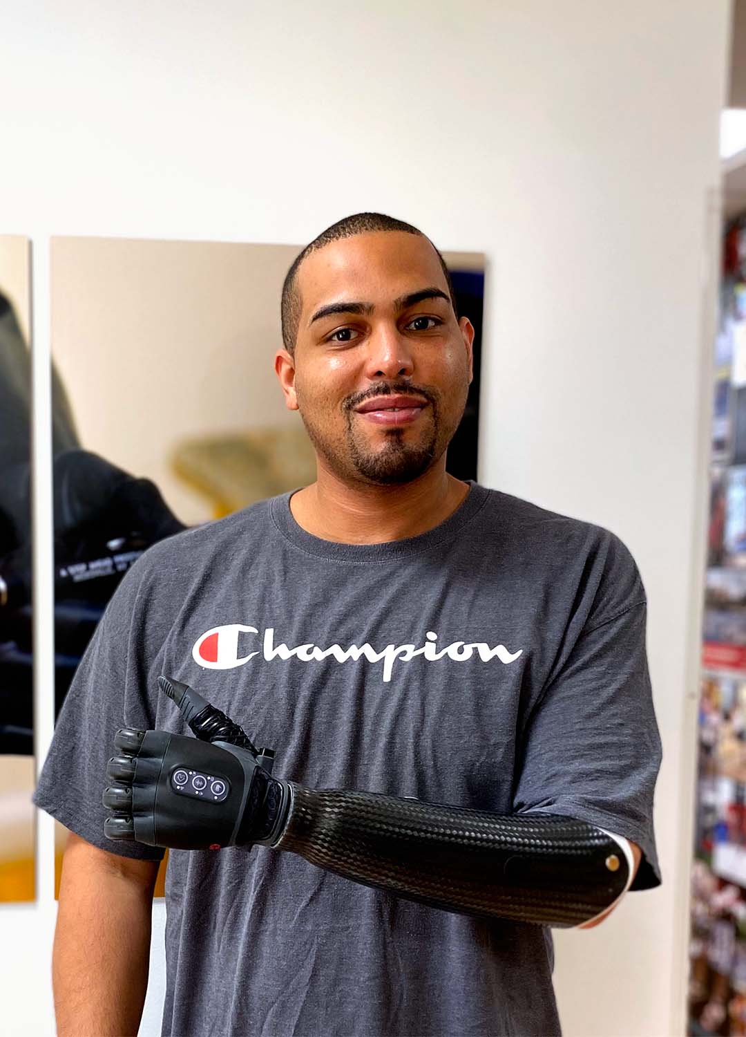 Prosthetic hand technology thumbs up