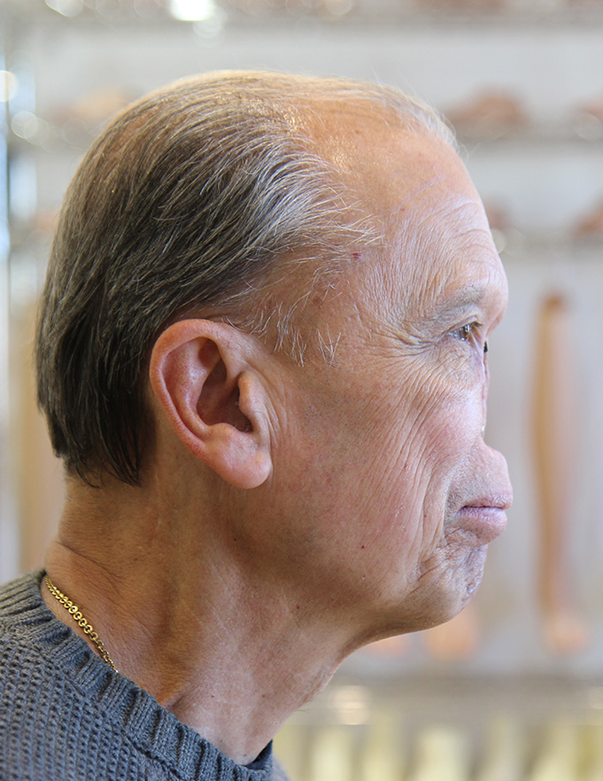 Digitaly planned and sculpted facial prosthetics