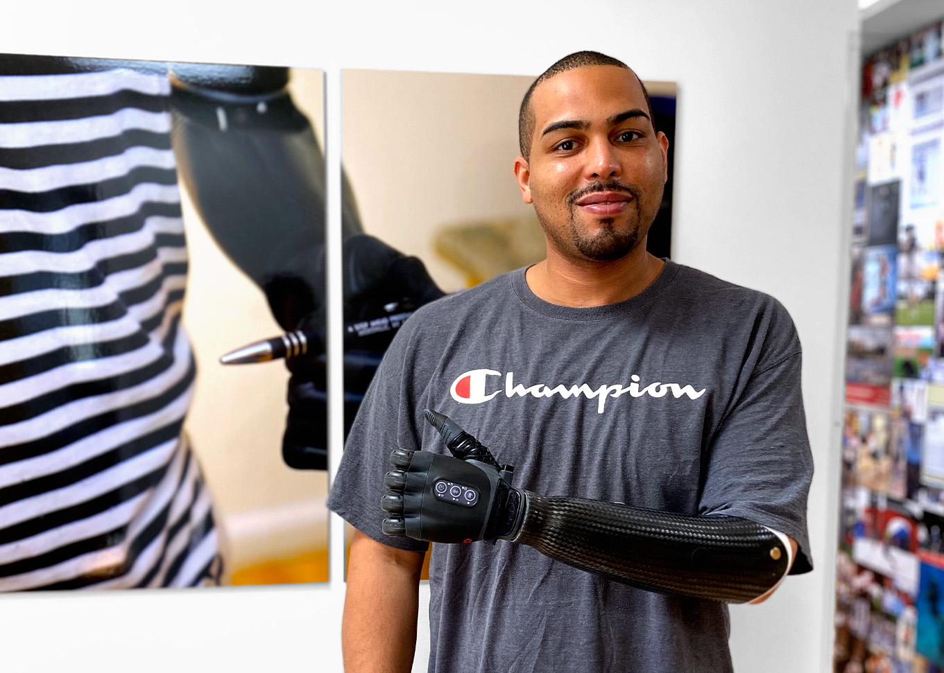 articulating prosthetic arm for below elbow amputee